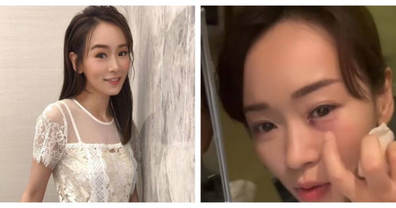 女星遭道具槍重擊「捅眼窩」⋯差1公分恐失明　驚人傷勢曝光