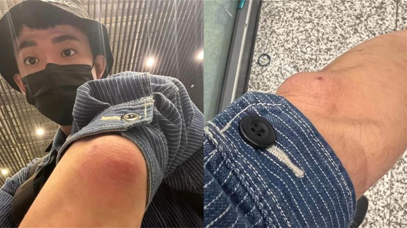 33歲阿滴手肘「腫成包子」緊急送醫！嚇壞恐要截肢？　診斷結果出爐了