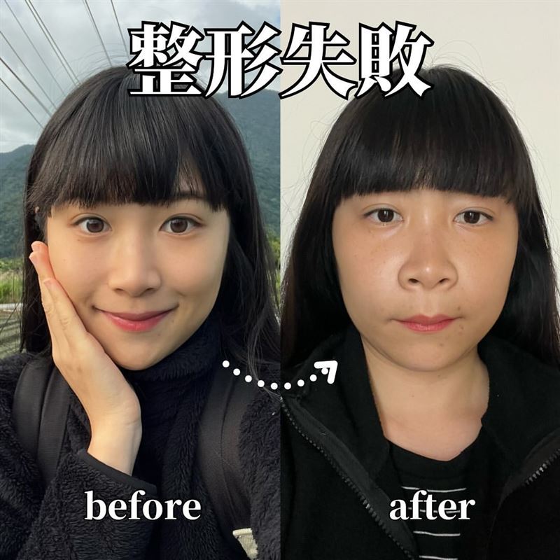 NanaQ自爆「整型失敗」不敢照鏡子！前後對比照曝光