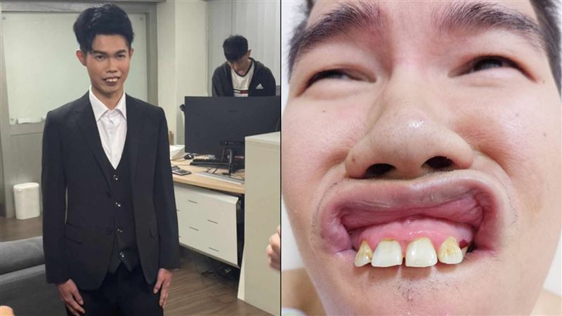 鄧佳華全口矯正「4顆大暴牙」！驚人6位數價格曝　網反對：自毀商標