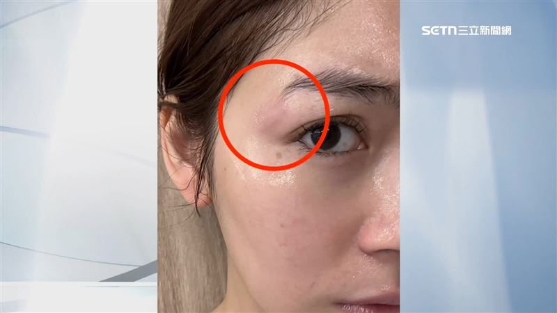 非首次出包?女星遭200度電棒捲燙傷臉 髮廊負評驚見「剪到耳朵流血」