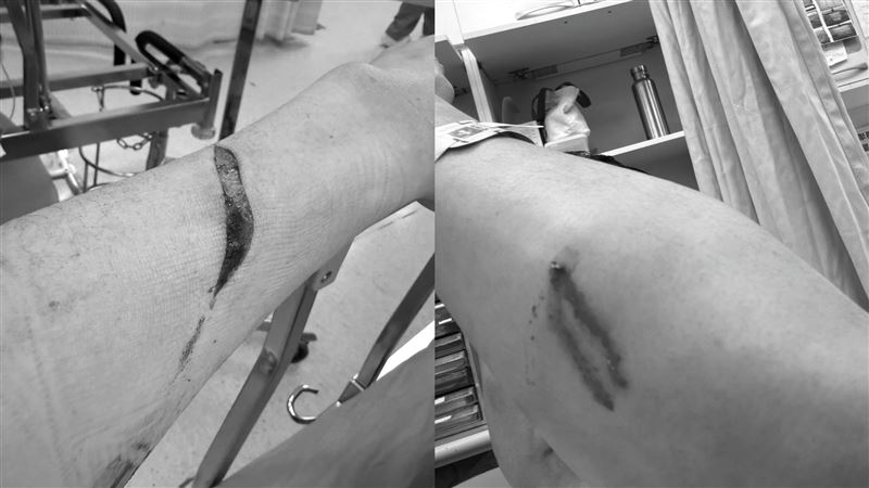 夏天倫遭砍濺血深夜發「左手10多公分傷照」曝心聲：替朋友擋一刀