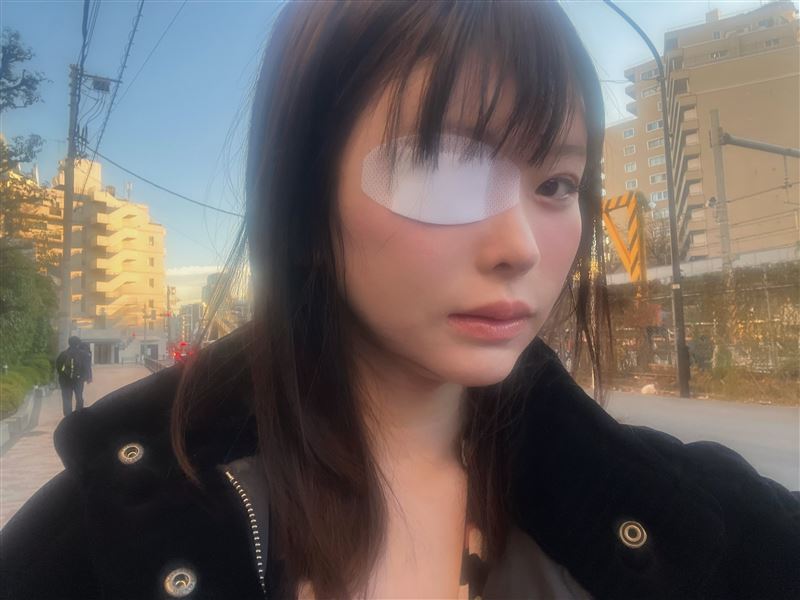 變成獨眼龍!AV女優被前男友「打到受傷」 她認了:不是第一次被家暴