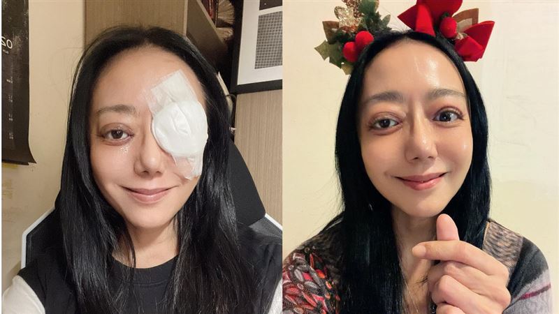 做好失明準備！三金女星「三度手術」最新近照曝現況：剩最後一次了